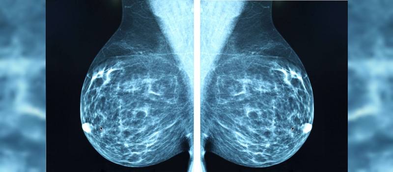 mamografi